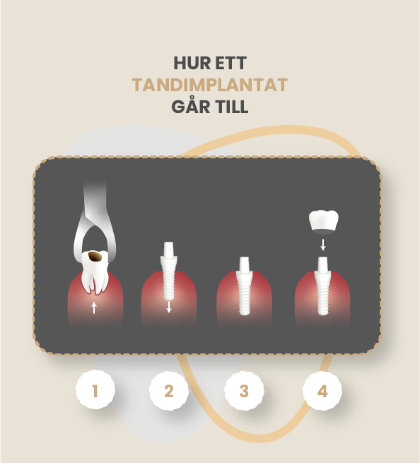 Asset 1@2x 1 Tandimplantat i Malmö