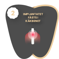 Asset 3@2x 1 Tandimplantat i Malmö